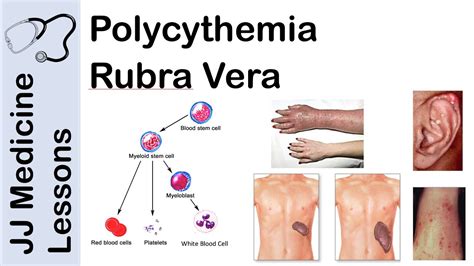 Polycythemia Vera ~ news word