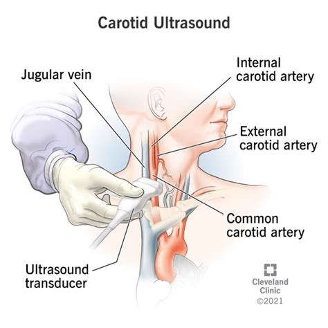 Carotid Ultrasound: Purpose, Procedure and Results