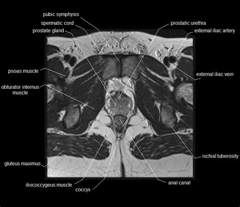 MRI pelvis Anatomy | Free Male Pelvis Axial Anatomy