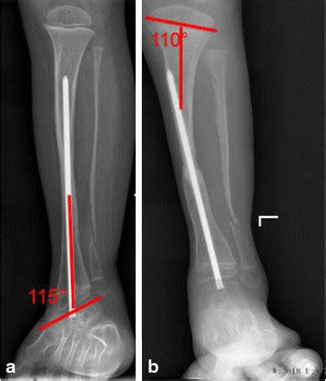 The evaluation on X-ray. Illustrations of the measurements of ankle ...