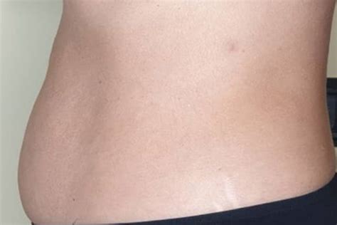 Cryolipolysis - AlQudrahMC