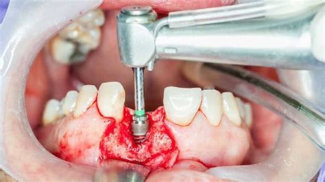 What Can You Expect from Your Dental Implant Surgery?