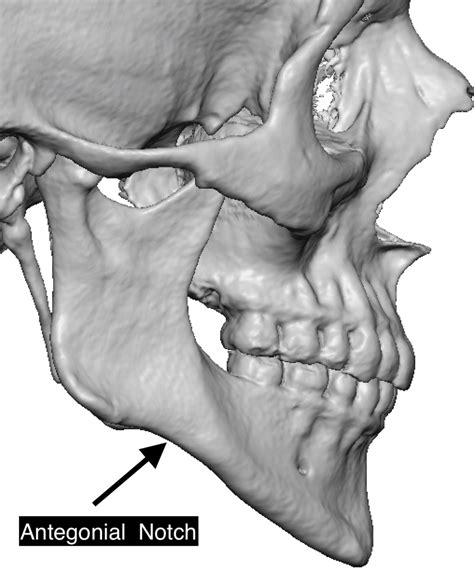 Plastic Surgery Case Study - Custom Jaw Angle Implants for Correction of the Steep Mandibular ...