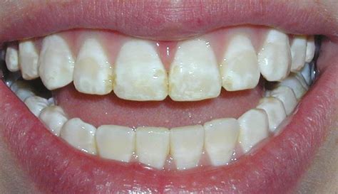 fluorosis