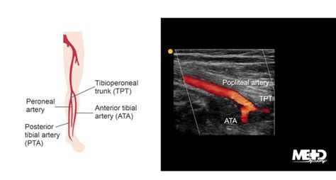 Peroneal Artery Ultrasound