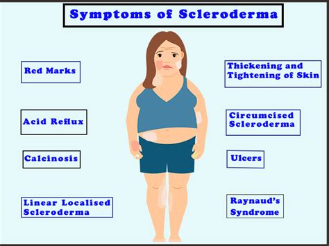 Scleroderma Pic 1