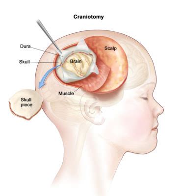 what are the instruments used in spinal and craniotomy surgery?