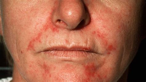 Seborrheic Dermatitis on Face Treatment, Symptoms and Pictures