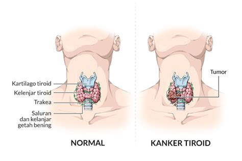 Kanker Tiroid - Gejala, penyebab dan mengobati - Alodokter