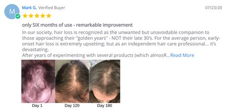 Kiierr-laser-cap-for-hair-growth-before_after-image - Beauty Smart Care