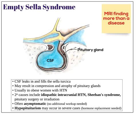 Empty sella syndrome - Medicine Keys for MRCPs