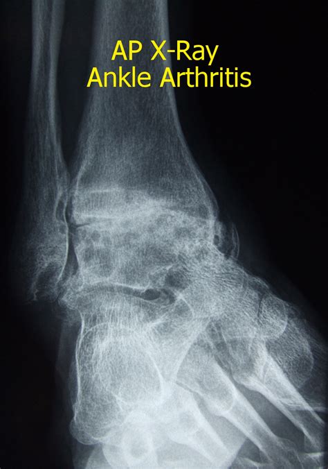 Ankle Arthritis — Stanmore foot & ankle surgery