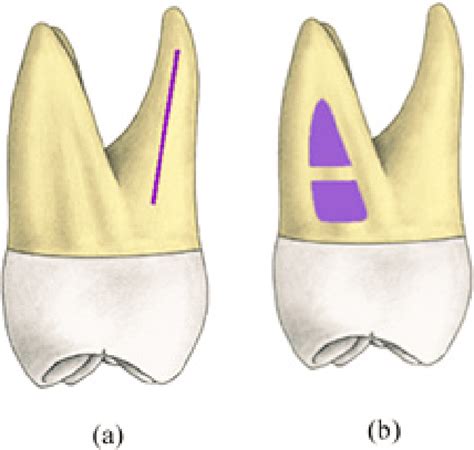 Mesial aspect of maxillary second molar roots (reprinted from 3D tooth... | Download Scientific ...