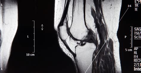 Diagnosing MCL Sprains and Tears