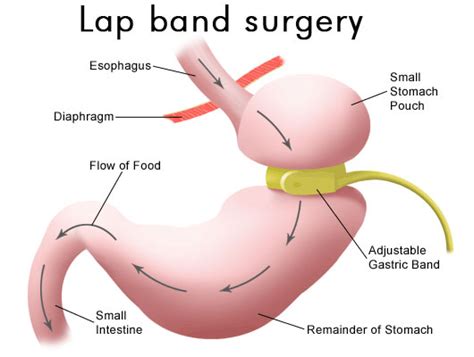 Lap Band Surgery In Tijuana, Mexico – MX Bariatrics