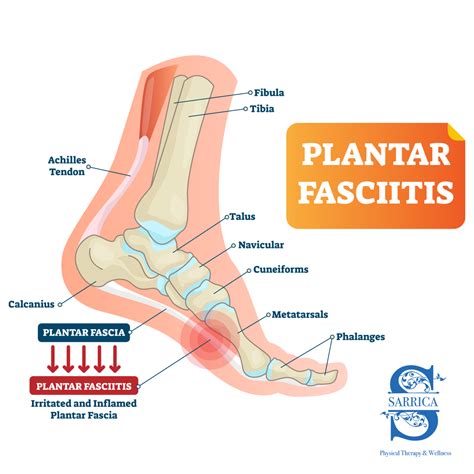 Plantar Fasciitis Symptoms, Treatments | How Physical Therapists Can ...