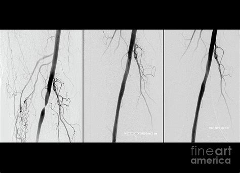 Treating Nearly Blocked Femoral Artery Photograph by Zephyr/science Photo Library | Fine Art America