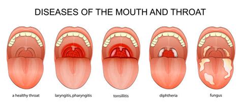 Chlamydia Throat Treatment