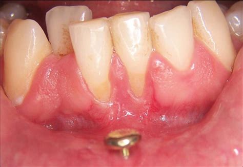 Oral health risks of tongue piercings | News | Dentagama