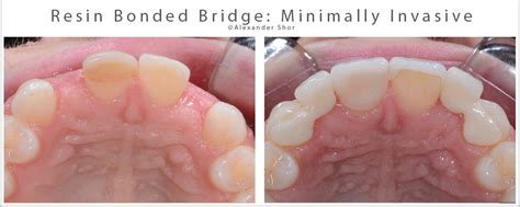 Resin Bonded Bridge: Minimally Invasive Option for Tooth Replacement - Shor Dental