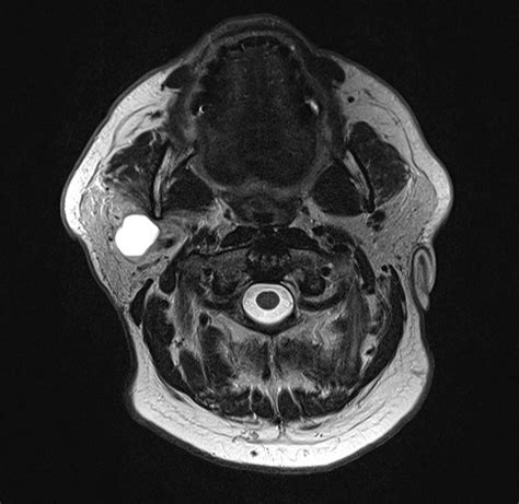 Mass in the right parotid gland seen in the original MRI scan, June... | Download Scientific Diagram