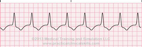 Accelerated Idioventricular Rhythm ECG Interpretation with Sample Strip