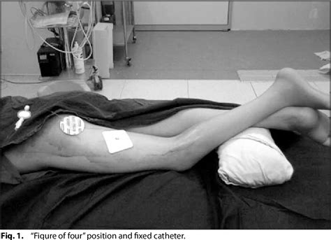 [PDF] "Figure of four" position and long-axis sciatic nerve scan with ultrasound facilitates ...