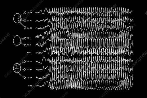 Brain waves in epilepsy - Stock Image M150/0288 - Science Photo Library