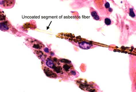 Lung - Asbestosis - Asbestos body | Asbestos fibers that rea… | Flickr