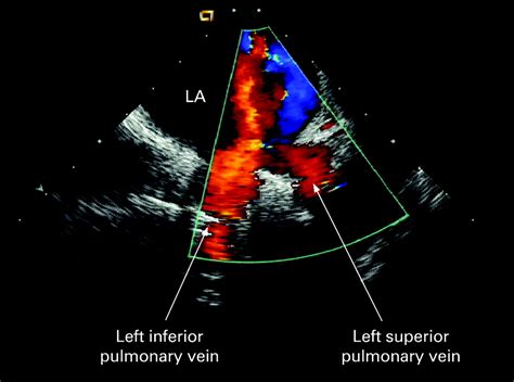 Intracardiac echocardiography | Heart