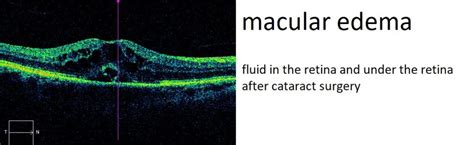 Causes and Treatment of Macular Edema (ME) | SKRetina