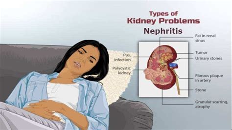 Nephritis: Symptoms, Causes, Types and Treatment | by Healthlinz Healthadvice | Medium