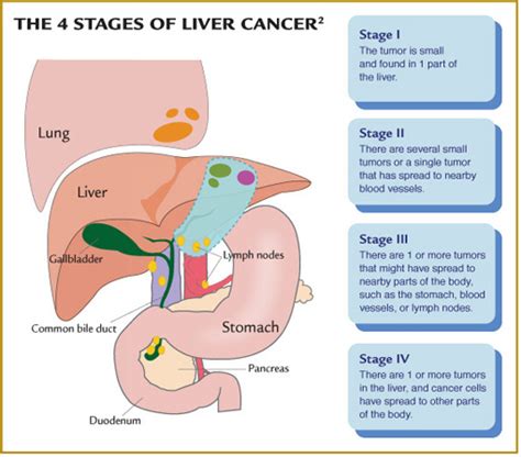 Cancer Symptoms: Cancer Final Stages Symptoms