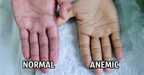 6 symptoms of anemia