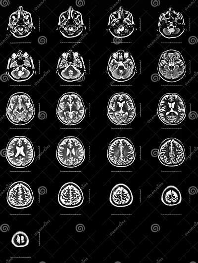 Sequence of Horizontal Sections of a Human Brain Stock Image - Image of ...