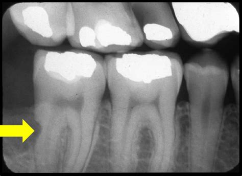 Case of the Week: External resorption – Dr. G's Toothpix