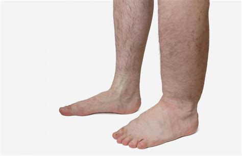 Causes of Leg & Ankle Swelling