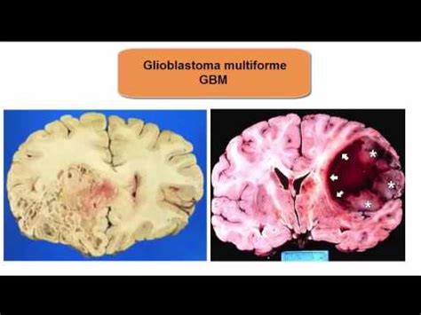 Glioblastoma Multiforme: what you need to know !! - YouTube