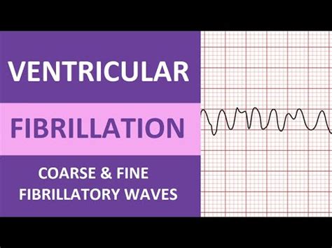 Ventricular Fibrillation (V-fib) ECG/EKG Nursing Review