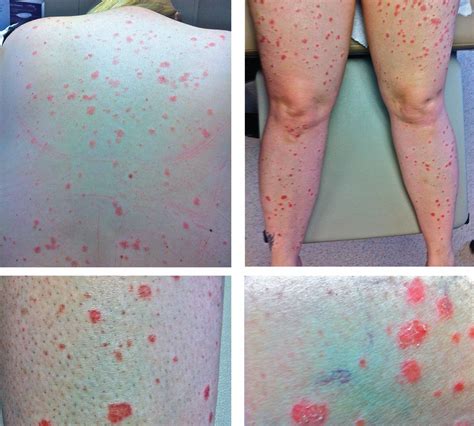 A rash after streptococcal infection | Cleveland Clinic Journal of Medicine