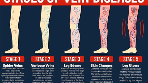 Treatment For Veins On Legs - Treat Choices