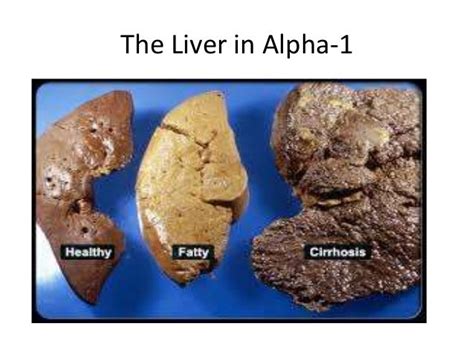 Alpha 1 antitrypsin deficiency