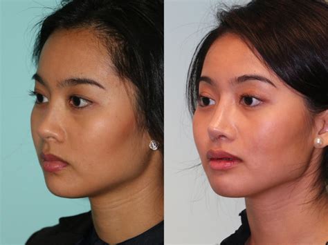 Rhinoplasty photos | Chevy Chase, MD | Patient 12632