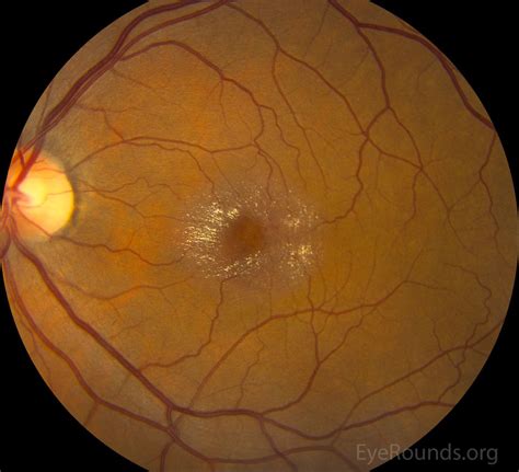 Idiopathic juxtafoveal telangiectasia type II (aka macular telangiectasia) Optician Training ...