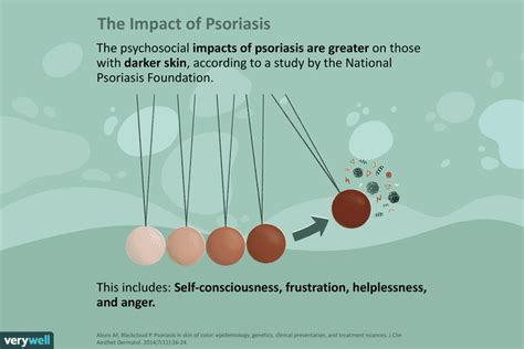 Psoriasis on Black Skin: Appearance, Diagnosis, Management