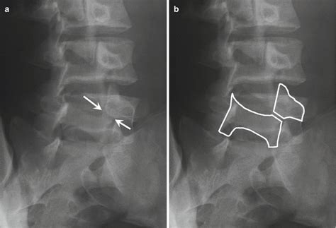 Pediatric Considerations In Sports Specific Injuries | Free Nude Porn Photos