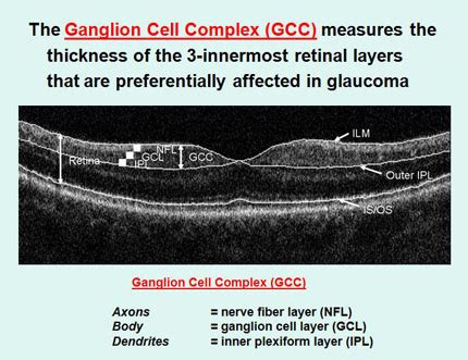 What Does FD-OCT Have to Offer for Glaucoma? | ophthalmologyweb.com