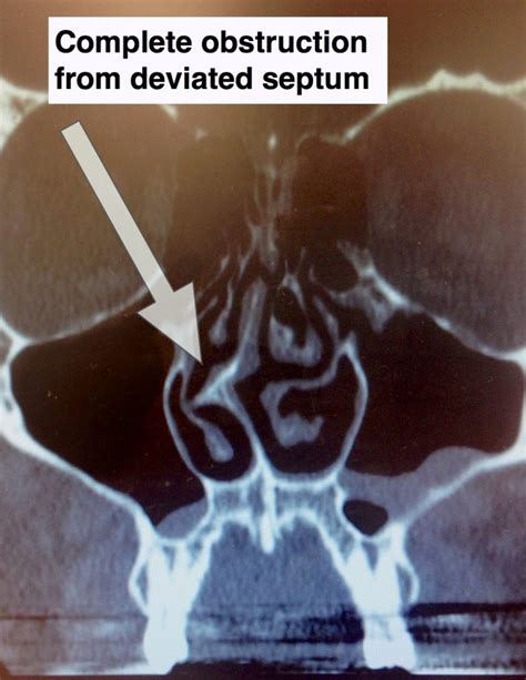 deviated septum - Charleston Facial Plastic Surgery