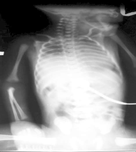 Chest X-ray showing elevated right side of diaphragm | Download Scientific Diagram