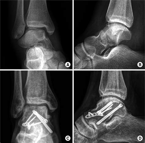 (A, B) Preopertive radiographs show a comminuted talar neck fracture ...